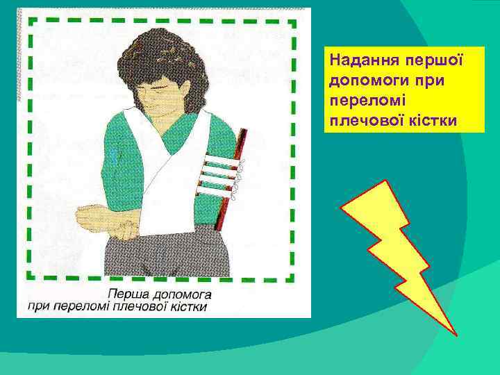Надання першої допомоги при переломі плечової кістки stack trace: 