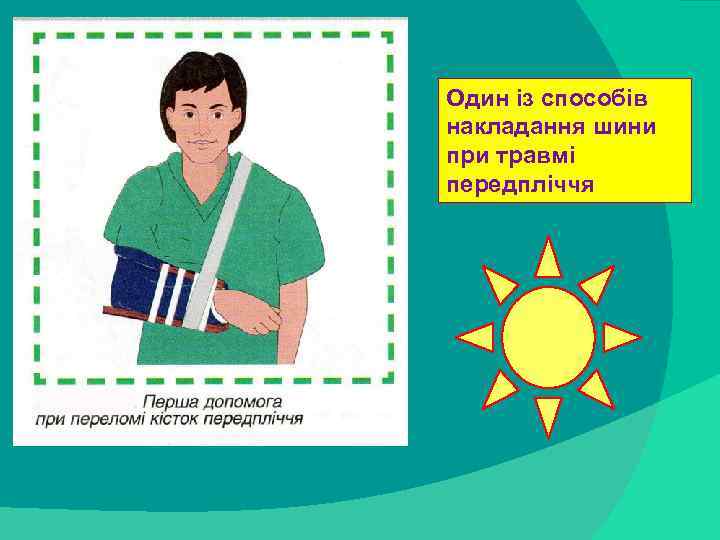 Один із способів накладання шини при травмі передпліччя stack trace: 