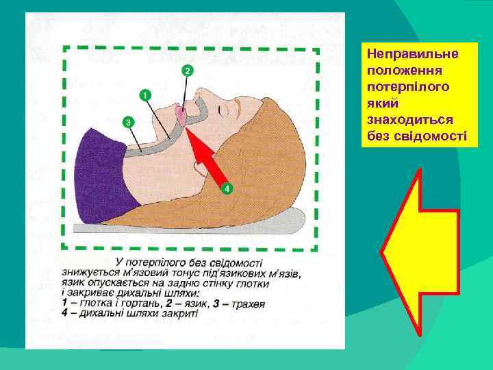Неправильне положення потерпілого який знаходиться без свідомості stack trace: 