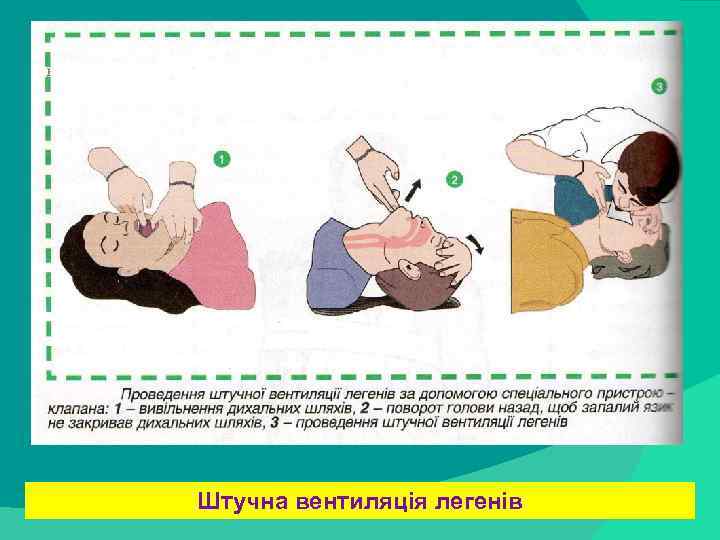 stack trace: Штучна вентиляція легенів 