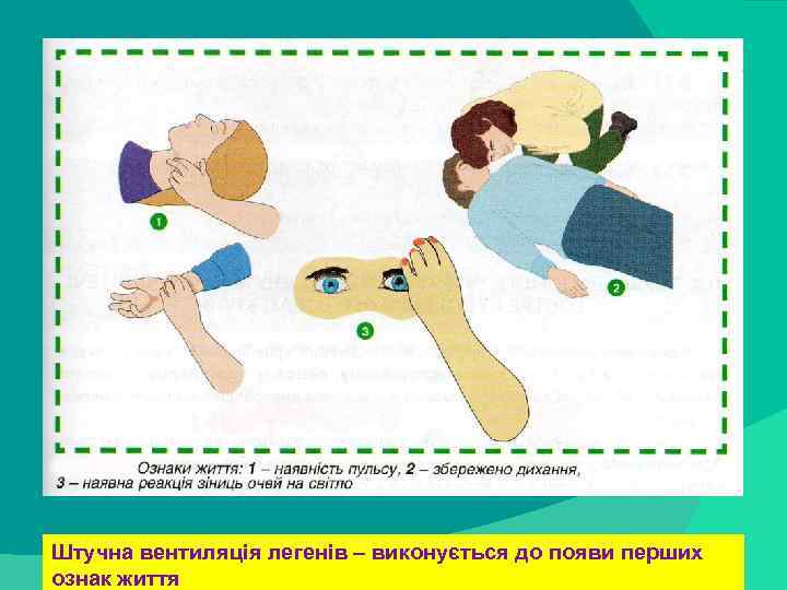 stack trace: Штучна вентиляція легенів – виконується до появи перших ознак життя 