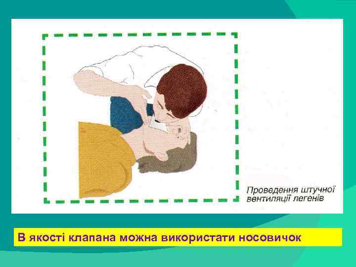 stack trace: В якості клапана можна використати носовичок 