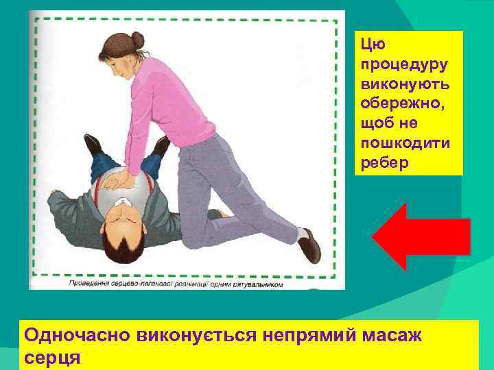 stack trace: Цю процедуру виконують обережно, щоб не пошкодити ребер Одночасно виконується непрямий масаж