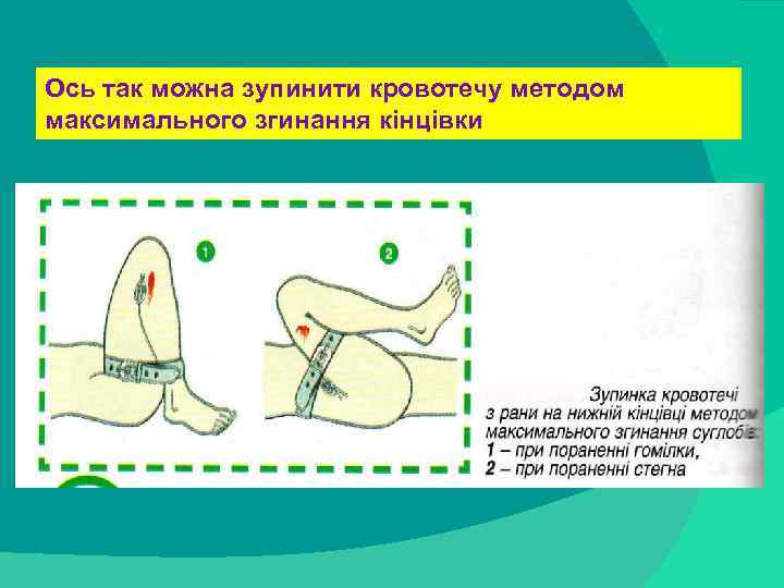 Ось так можна зупинити кровотечу методом максимального згинання кінцівки stack trace: 