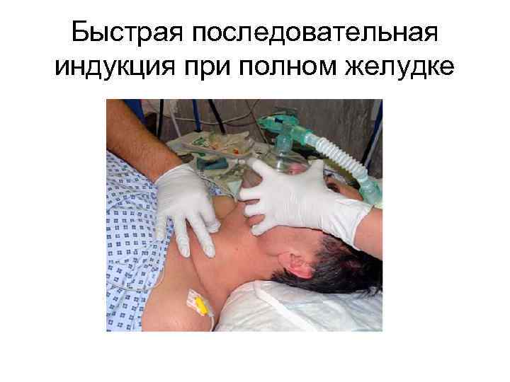 Быстрая последовательная индукция при полном желудке 