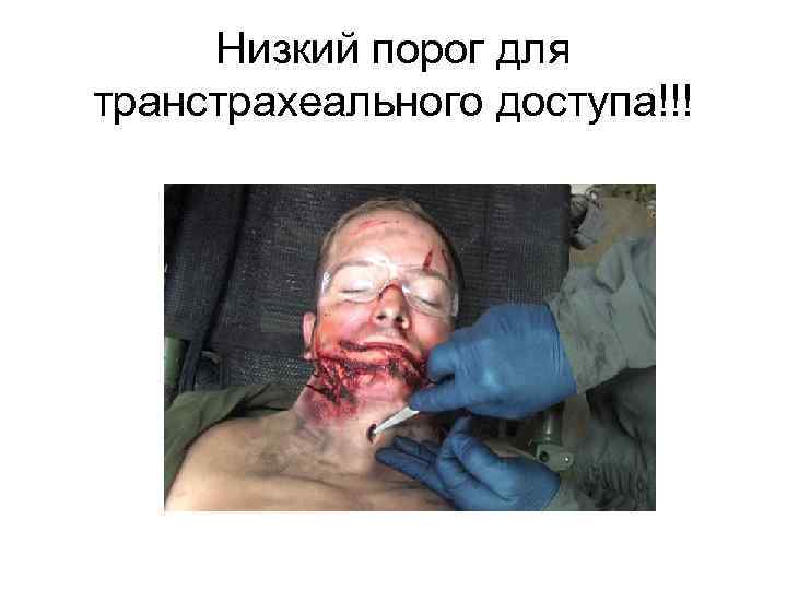 Низкий порог для транстрахеального доступа!!! 