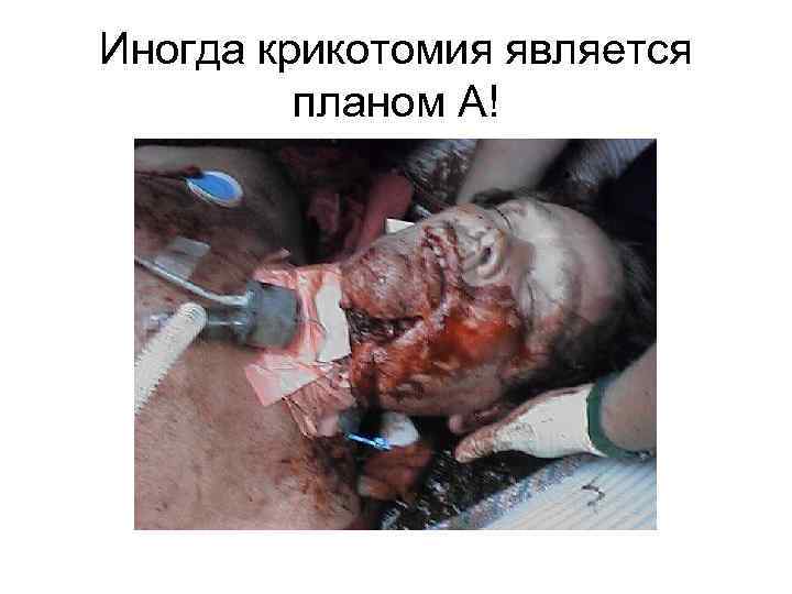Иногда крикотомия является планом А! 