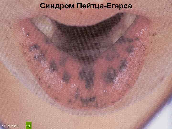 Синдром Пейтца-Егерса На протяжении многих десятков лет менялось представление о влияние ультрафиолета на кожу: