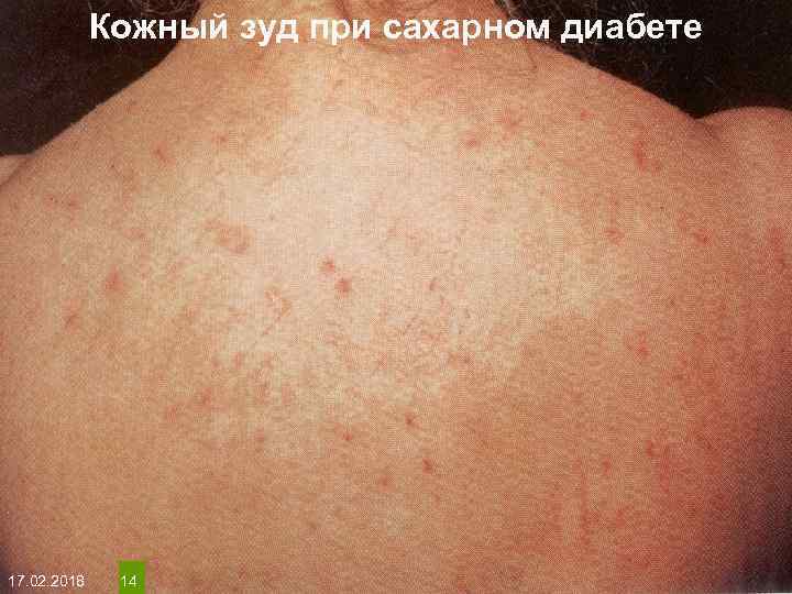 Кожный зуд при сахарном диабете На протяжении многих десятков лет менялось представление о влияние