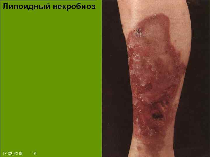 Липоидный некробиоз На протяжении многих десятков лет менялось представление о влияние ультрафиолета на кожу: