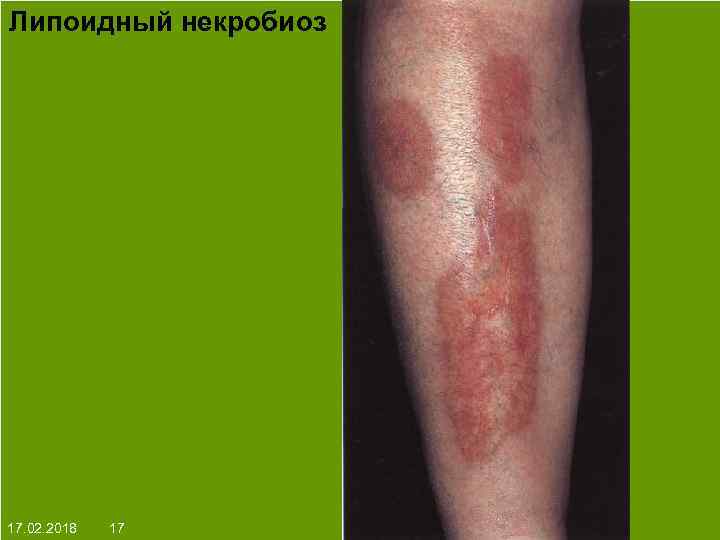 Липоидный некробиоз На протяжении многих десятков лет менялось представление о влияние ультрафиолета на кожу: