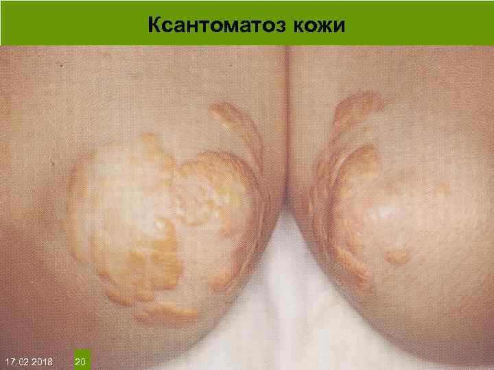 Ксантоматоз кожи На протяжении многих десятков лет менялось представление о влияние ультрафиолета на кожу: