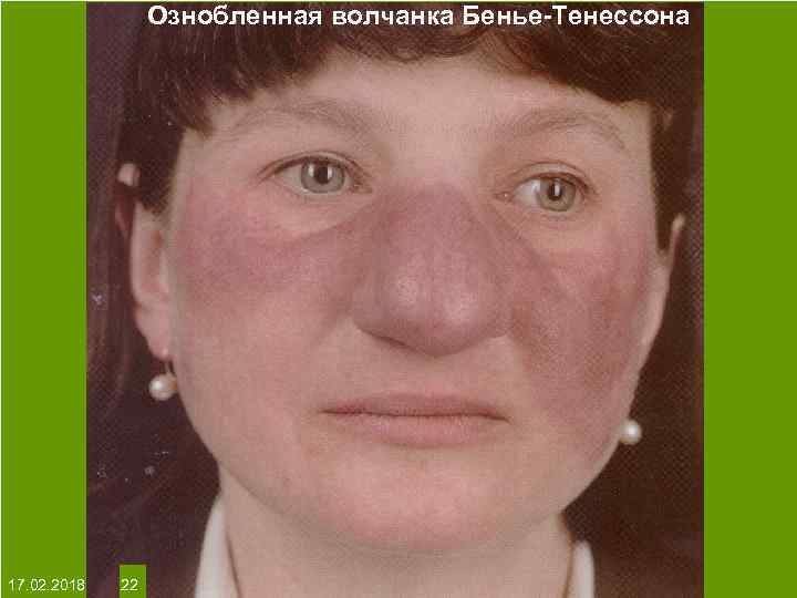 Ознобленная волчанка Бенье-Тенессона На протяжении многих десятков лет менялось представление о влияние ультрафиолета на