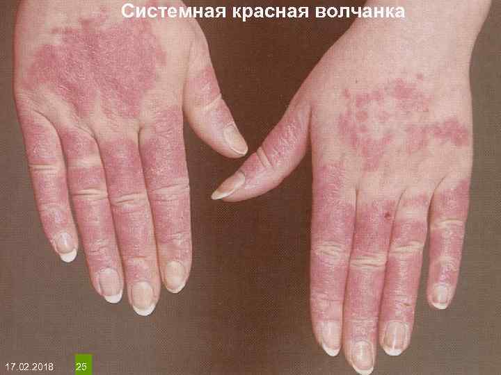 Системная красная волчанка На протяжении многих десятков лет менялось представление о влияние ультрафиолета на