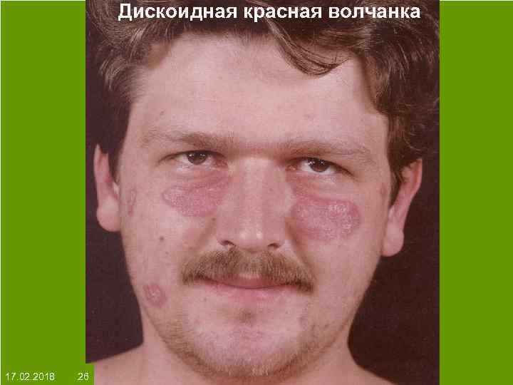 Дискоидная красная волчанка На протяжении многих десятков лет менялось представление о влияние ультрафиолета на