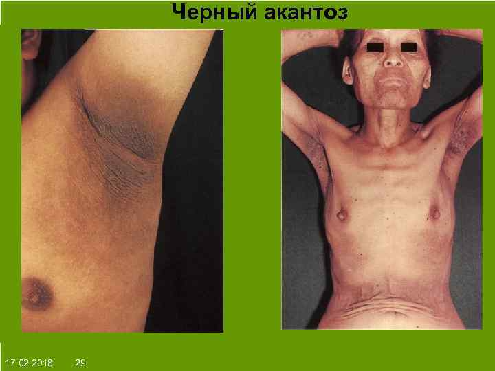 Черный акантоз На протяжении многих десятков лет менялось представление о влияние ультрафиолета на кожу: