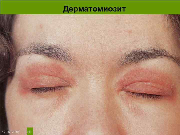 Дерматомиозит На протяжении многих десятков лет менялось представление о влияние ультрафиолета на кожу: от