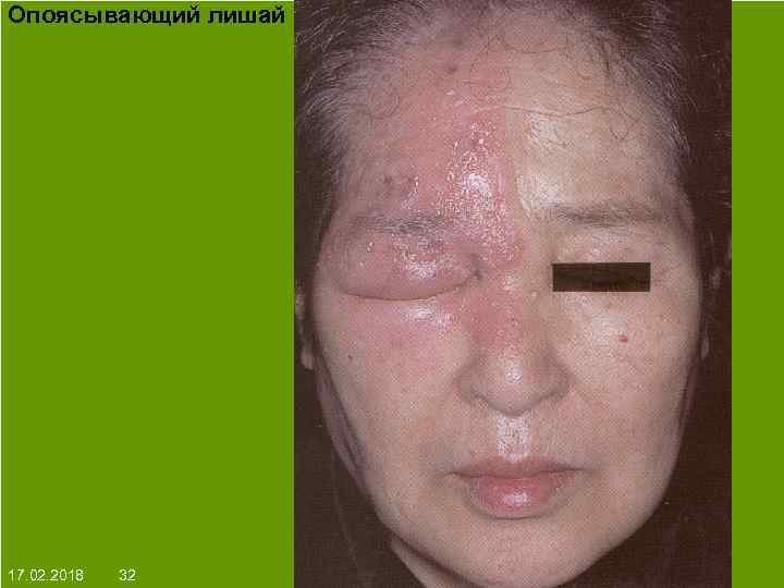 Опоясывающий лишай На протяжении многих десятков лет менялось представление о влияние ультрафиолета на кожу: