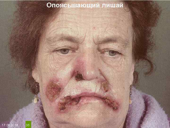 Опоясывающий лишай На протяжении многих десятков лет менялось представление о влияние ультрафиолета на кожу: