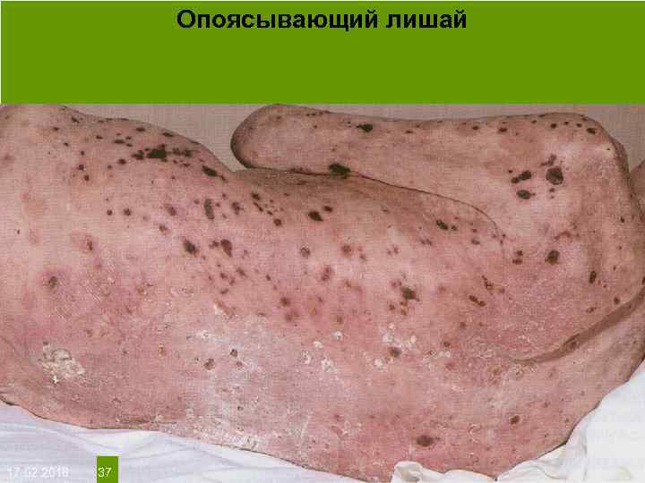 Опоясывающий лишай На протяжении многих десятков лет менялось представление о влияние ультрафиолета на кожу: