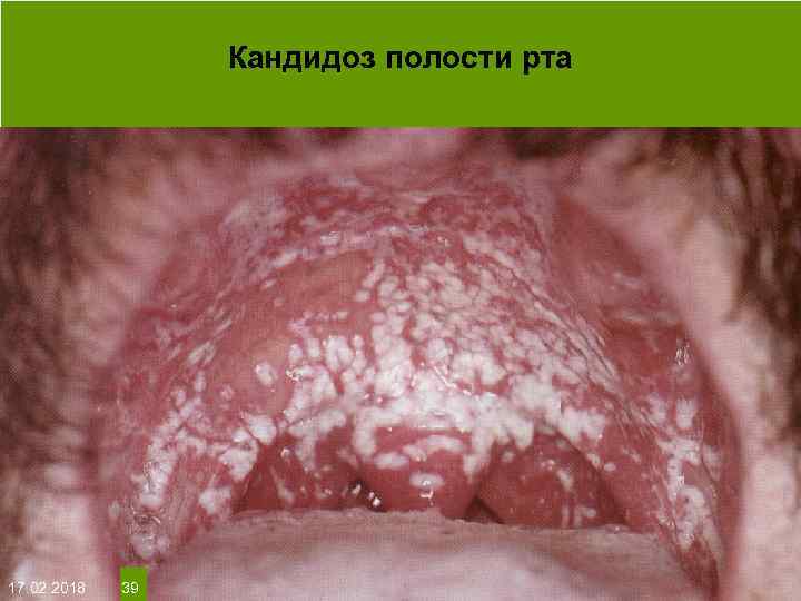 Кандидоз полости рта На протяжении многих десятков лет менялось представление о влияние ультрафиолета на