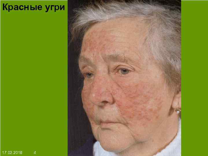 Красные угри На протяжении многих десятков лет менялось представление о влияние ультрафиолета на кожу: