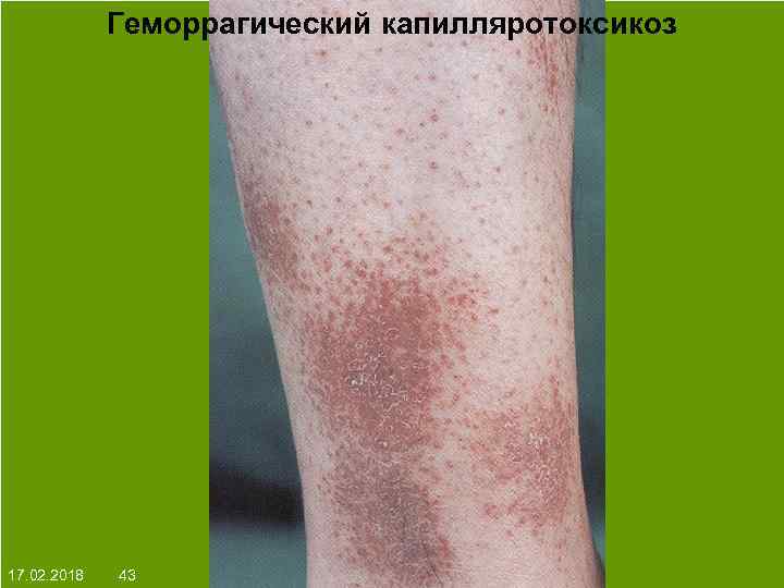 Геморрагический капилляротоксикоз На протяжении многих десятков лет менялось представление о влияние ультрафиолета на кожу: