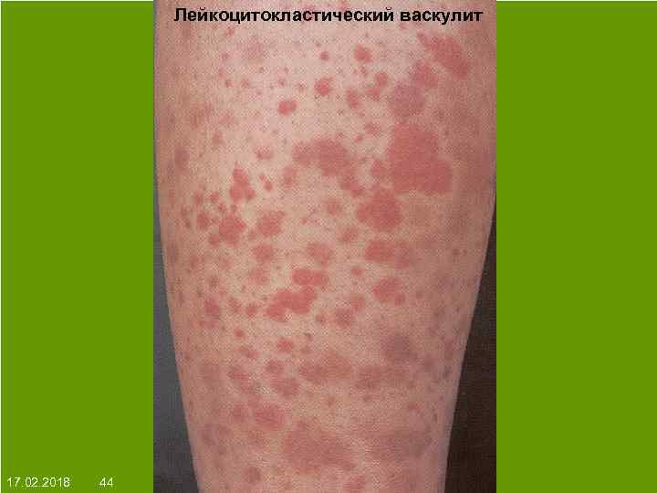 Лейкоцитокластический васкулит На протяжении многих десятков лет менялось представление о влияние ультрафиолета на кожу: