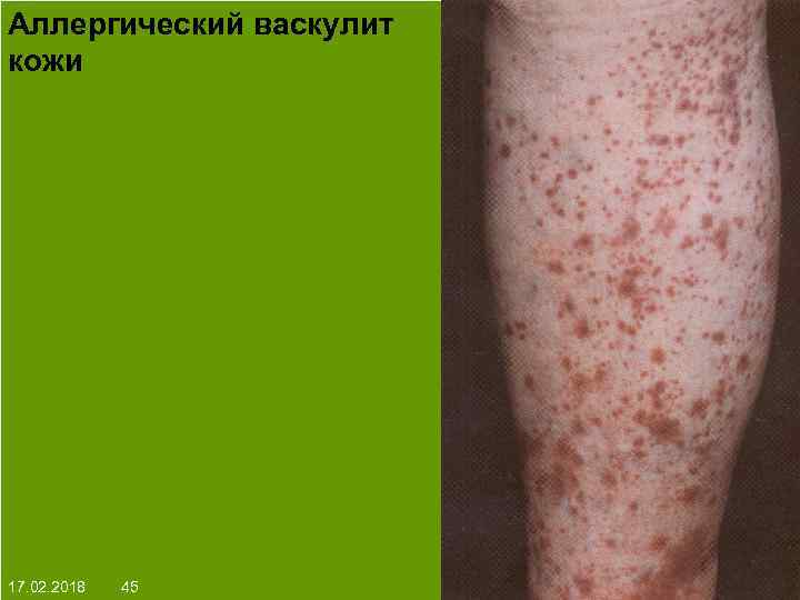 Аллергический васкулит кожи На протяжении многих десятков лет менялось представление о влияние ультрафиолета на