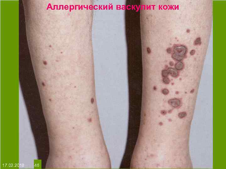 Аллергический васкулит кожи На протяжении многих десятков лет менялось представление о влияние ультрафиолета на