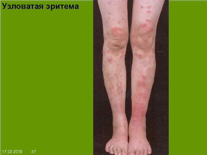 Узловатая эритема На протяжении многих десятков лет менялось представление о влияние ультрафиолета на кожу: