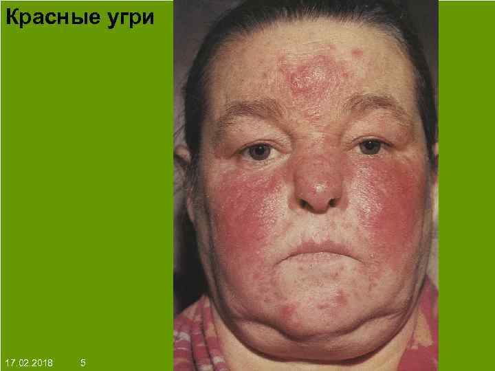 Красные угри На протяжении многих десятков лет менялось представление о влияние ультрафиолета на кожу: