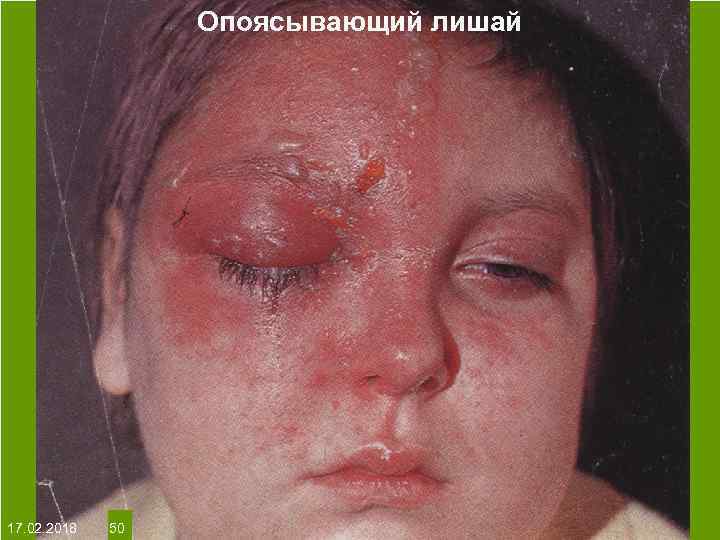 Опоясывающий лишай На протяжении многих десятков лет менялось представление о влияние ультрафиолета на кожу: