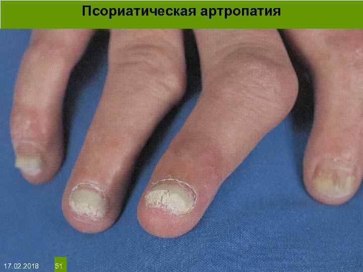 Псориатическая артропатия На протяжении многих десятков лет менялось представление о влияние ультрафиолета на кожу: