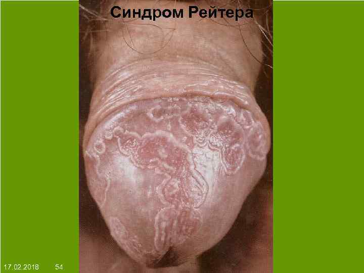 Синдром Рейтера На протяжении многих десятков лет менялось представление о влияние ультрафиолета на кожу: