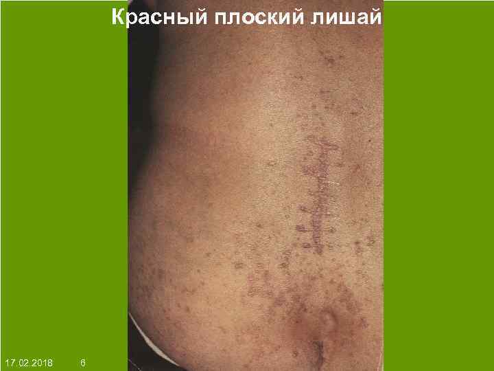 Красный плоский лишай На протяжении многих десятков лет менялось представление о влияние ультрафиолета на