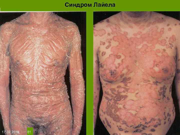 Синдром Лайела На протяжении многих десятков лет менялось представление о влияние ультрафиолета на кожу: