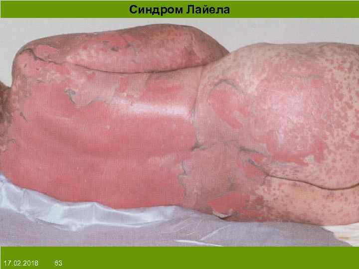 Синдром Лайела На протяжении многих десятков лет менялось представление о влияние ультрафиолета на кожу: