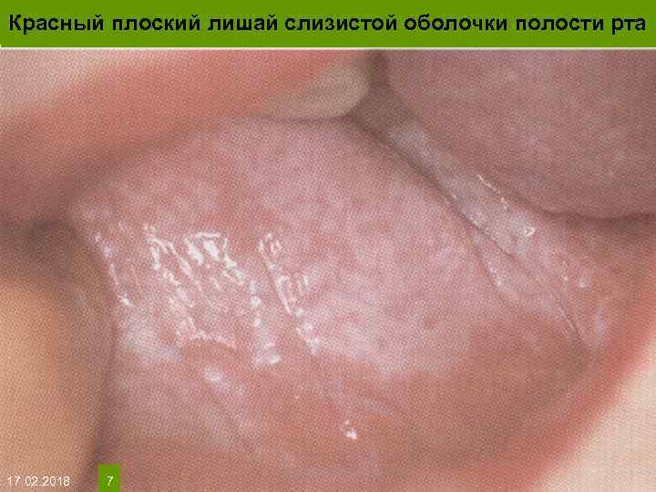 Красный плоский лишай слизистой оболочки полости рта На протяжении многих десятков лет менялось представление