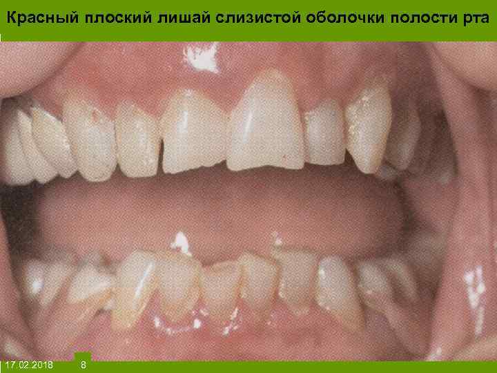 Красный плоский лишай слизистой оболочки полости рта На протяжении многих десятков лет менялось представление