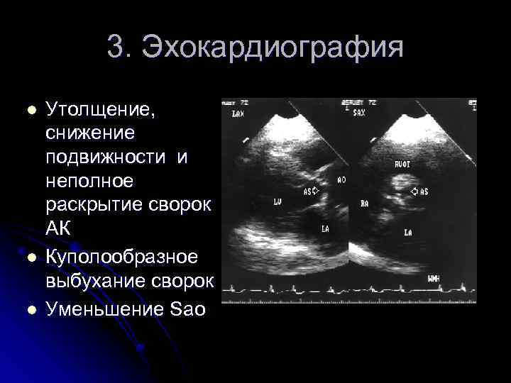 3. Эхокардиография l l l Утолщение, снижение подвижности и неполное раскрытие сворок АК Куполообразное