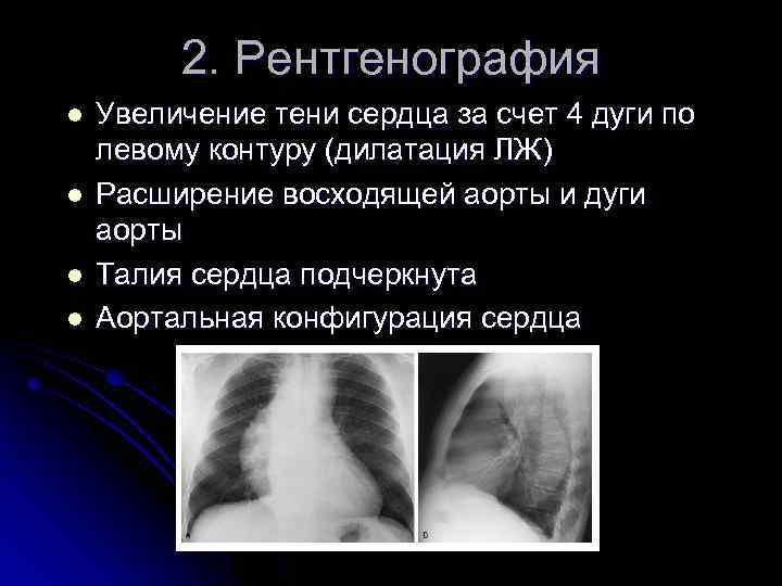 2. Рентгенография l l Увеличение тени сердца за счет 4 дуги по левому контуру