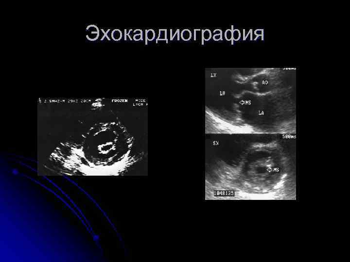 Эхокардиография 