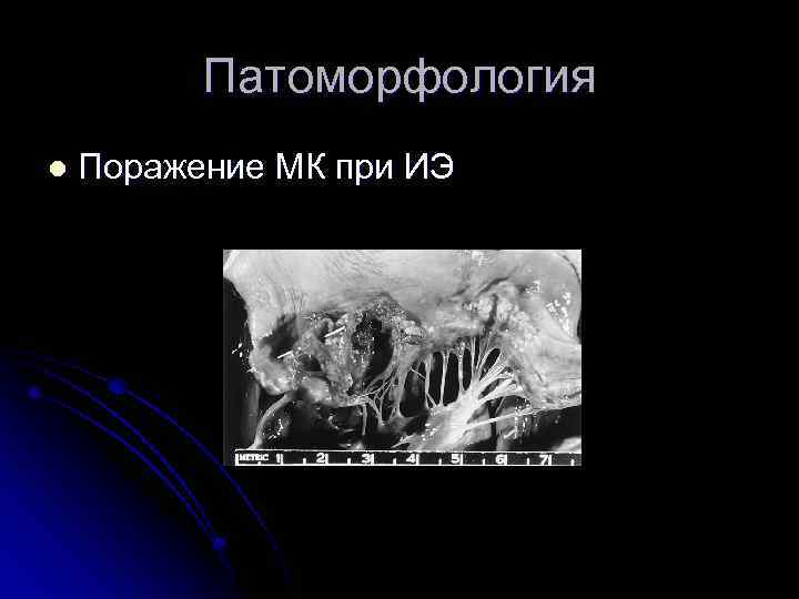 Патоморфология l Поражение МК при ИЭ 