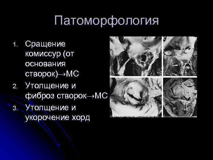 Патоморфология 1. 2. 3. Сращение комиссур (от основания створок)→МС Утолщение и фиброз створок→МС Утолщение