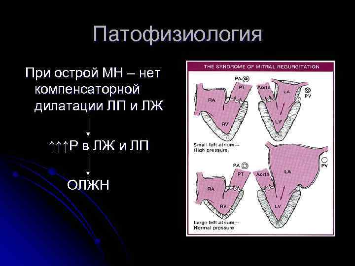 Патофизиология При острой МН – нет компенсаторной дилатации ЛП и ЛЖ ↑↑↑Р в ЛЖ