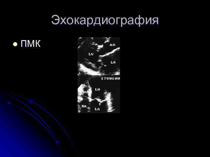 Эхокардиография l ПМК 