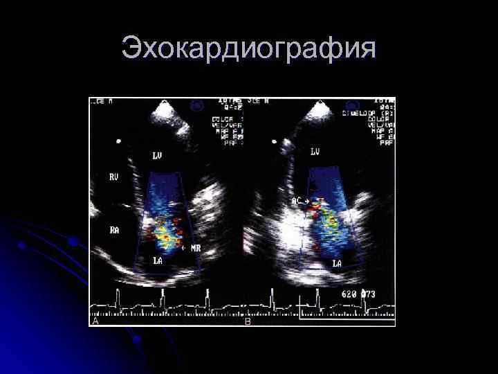 Эхокардиография 