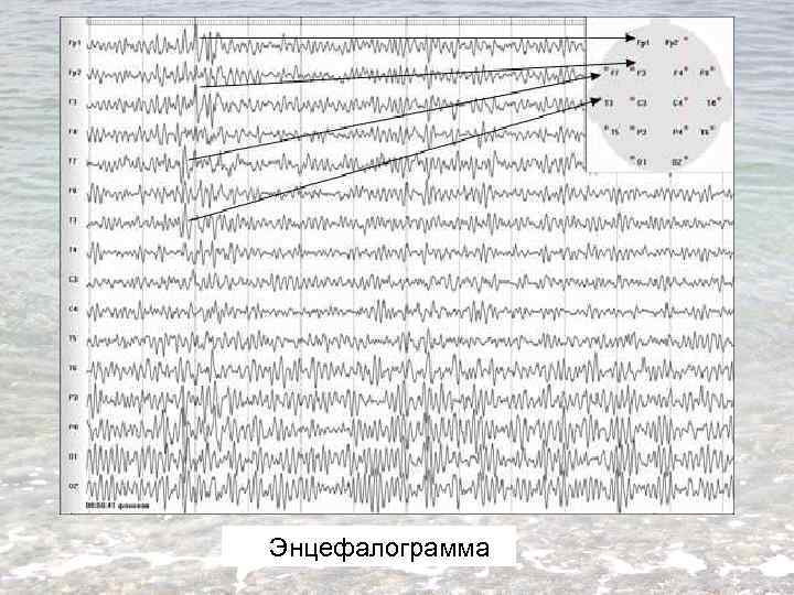 Энцефалограмма 