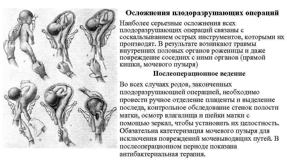 Осложнения плодоразрушающих операций Наиболее серьезные осложнения всех плодоразрушающих операций связаны с соскальзыванием острых инструментов,